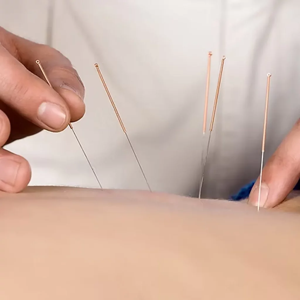 Acupuncture 02